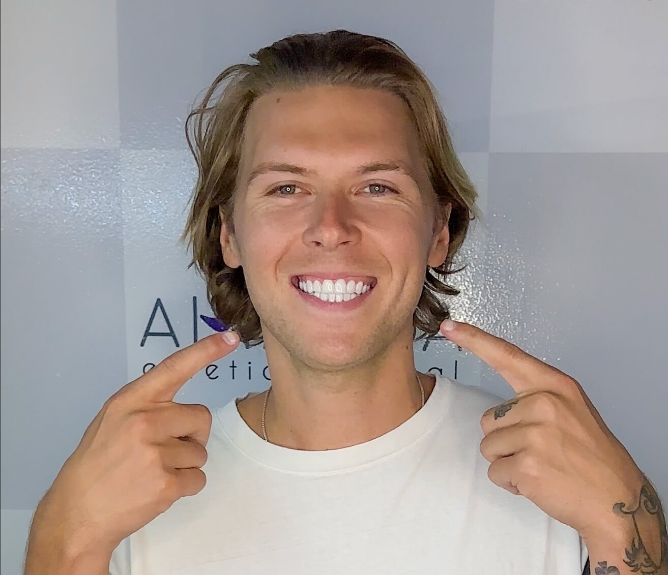 Do I Need Dental Veneers? 6 Signs to Know for Sure