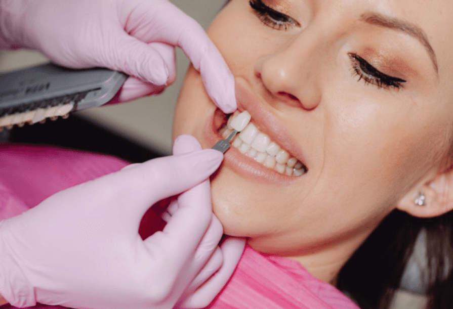 Dental Veneers in Mexico: Your Destination for a Dream Smile